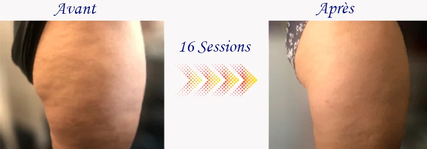Comparaison de l'aspect de la peau d'une jambe avant et après 16 séances avec l'appareil MRM, montrant une réduction remarquable de la cellulite.