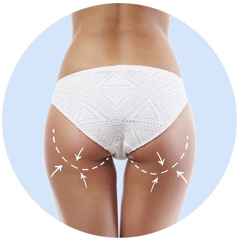 Fesses et cuisses avec des lignes et des flèches indiquant le raffermissement et le remodelage corporel grâce à des appareils esthétiques non invasifs.
