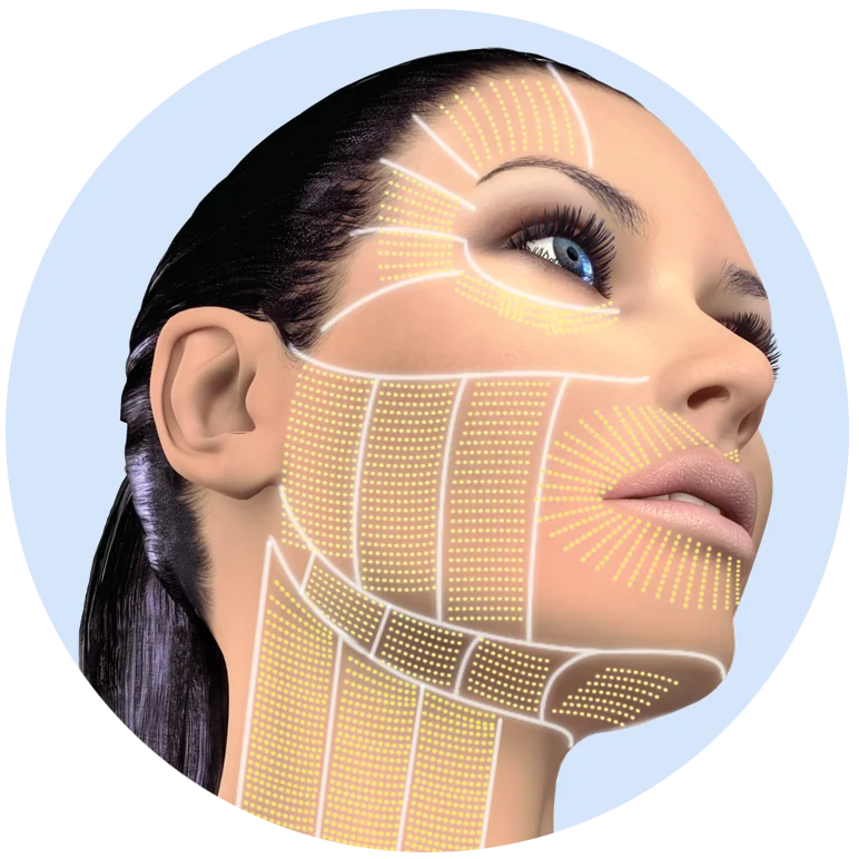 Visage féminin avec des lignes et des points indiquant les zones à traiter pour raffermir et rajeunir le visage à l'aide d'équipements esthétiques.
